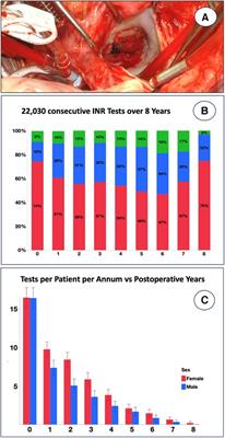 Mechanical valve replacement for patients with rheumatic heart disease: the reality of INR control in Africa and beyond